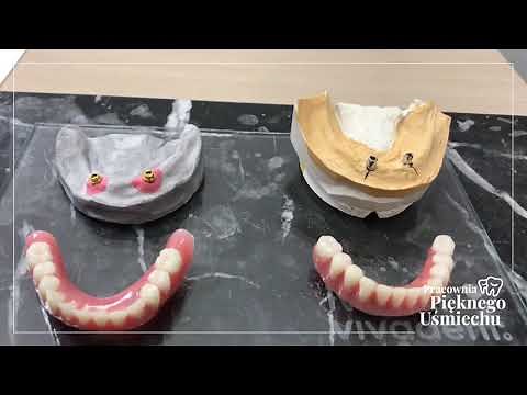 Proteza na lokatorach na implantach i Proteza na teleskopach na implantach