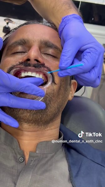 Documented Zirconium Crown Natural Shade Insights