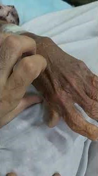Osteoarthritis of fingers | Heberden's Nodes