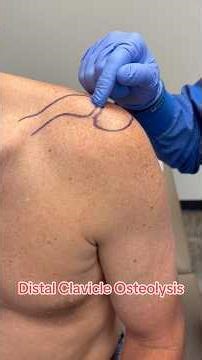 What’s Distal Clavicle Osteolysis? #medstudent #sportsmedicine #shoulderpain