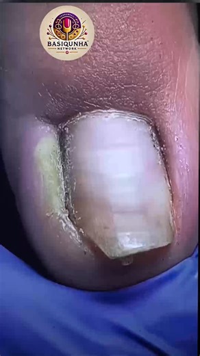 184K views · 1.2K reactions | Preventive Affordable Wellness Plans for Foot Health #SafeSteps #DiabeticFootCare #HealthyHabits | Basiquinha | Facebook