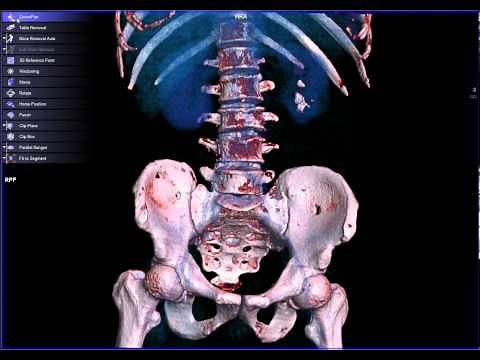 CT SCAN OF VERTEBRAE LUMBAR (3D)