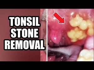 Tonsils Stone Removal, Causes & Treatment 2021