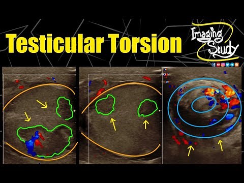 Testicular Torsion || Doppler || Ultrasound || Case 282