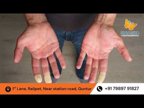 What is Scleroderma? Explained in Telugu | PRATYUSHA RHEUMATOLOGY CARE