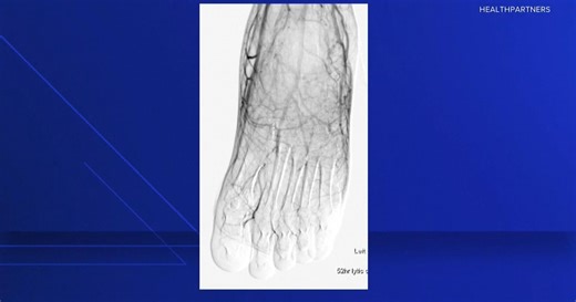 Frostbite safety and ways to treat it