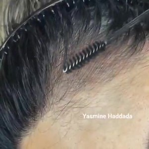 خدمت البارح على زبونتي ❤️🔥 رسم شعرة بشعرة لي ملئ فراغات الرأس و كأنو شعر حقيقي 😍 Hairline est une nouvelle technique manuelle de comblement des vides des cheveux par le dessin de fines lignes à l’aide d’un stylet muni d’une micro blade et d’un pigment similaire à la couleur de la carnation naturelle qui donnent un aspect de cheveux réels. une micropigmentation du cuir chevelu pour donner un effet de cheveux plus fournis #عاجل و حصري و لي أول مرة في مدينة #عنابة تقنية #hairline #microblading 😍