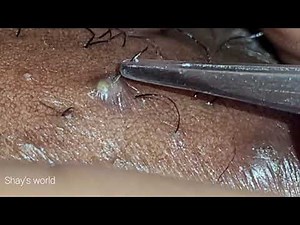 INGROWN HAIR REMOVAL #14
