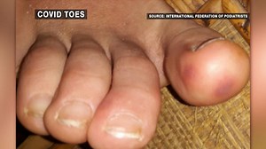 Doctors warn of mystery coronavirus symptom called 'COVID toes'