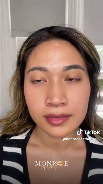 Pdo Threads Training for V Line and Facelift