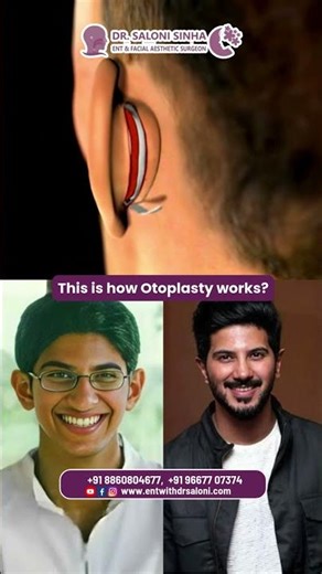 This is how Otoplasty Work?