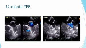 Percutaneous left atrial appendage closure (LAAC) is effective for stroke prevention in atrial fibrillation patients unable to tolerate OAC (oral anticoagulants). However, first generation Watchman had peri-device leaks for various reasons. Dr Horton presents a challenging procedure and his unique technique to treat a peri-Watchman device leak. Watch exclusively on CardioVisual app, share the video and discuss with peers. https://bit.ly/3fAkZnT #watchman #EPeeps #LAAClosure @HRSonline @AndreaNat