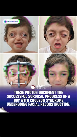 Before this, he couldn't breathe properly. Crouzon syndrome is a rare genetic condition affecting about 1 in 60,000 births. The bones in the skull fuse too early, a process called craniosynostosis. When those bones stop expanding at the right time, the face can't grow forward the way it should. The midface stays underdeveloped. The eye sockets remain shallow, causing the eyes to bulge outward. The airways don't open up enough, leading to obstructive sleep apnea and serious breathing problems. Th