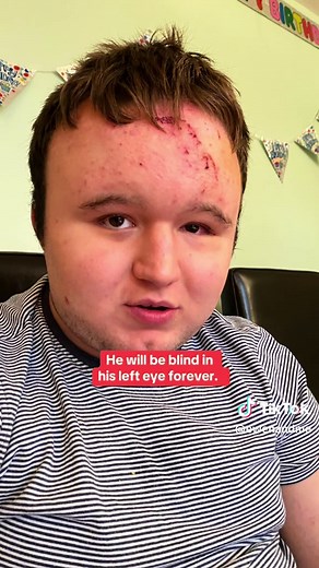 Ewen's Eye Injury and Awareness on Self-Injurious Behavior