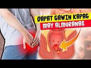 3 Paraan Na Dapat Gawin Kapag May Almoranas | Hemorrhoids Symptoms And Treatments