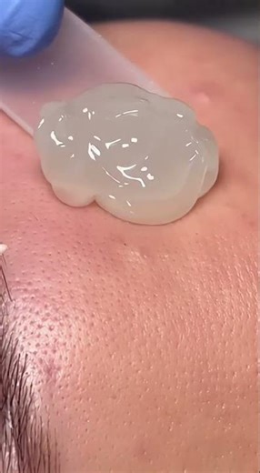 Satisfying Forehead Blackhead Extraction #skincare #trending