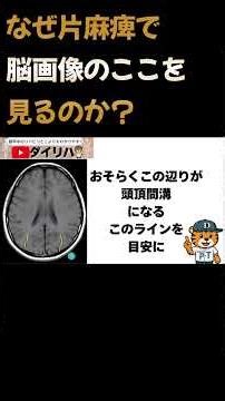 Why do we look at this part of brain images in hemiplegia? #Physiotherapist #BrainImage