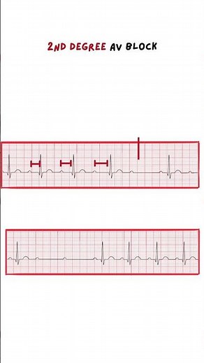 Wenckebach & Mobitz/ 2nd degree AV Block #ecg #medicine #medical #medicalstudent #doctor #nurse