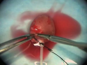 A Murine Closed-chest Model of Myocardial Ischemia and Reperfusion