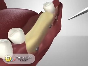 Bone Augmentation. Credit @tooth& goacademy #Dentistry #LearningTips | Bites & Braces Dental