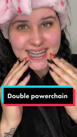 When Do You Get Your Braces Off? My Experience