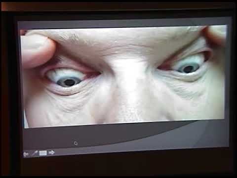 A Patient with Alternating Skew Deviation & Down-Beat Nystagmus