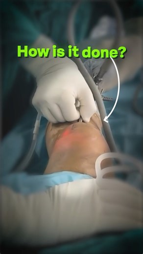 What is Knee Arthroscopy? -#drpankajwalecha #kneeosteoarthritis #arthroscopicsurgery