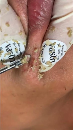 Can you count these blackheads