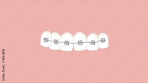 Video animation of braces straightening teeth