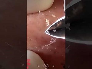 Acne Treatment & Blackhead Removal | Very Satisfying Pimple Popping #079