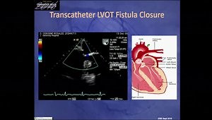 Paravalvular Leak: How Do We Approach It?