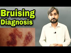 Bruising | Causes | Diagnosis | Treatment