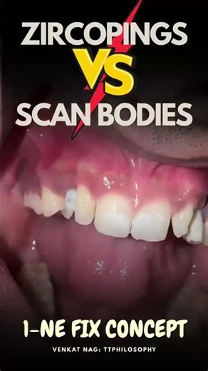Zircoping vs Scan Body | Best Implant Surgeon in Hyderabad