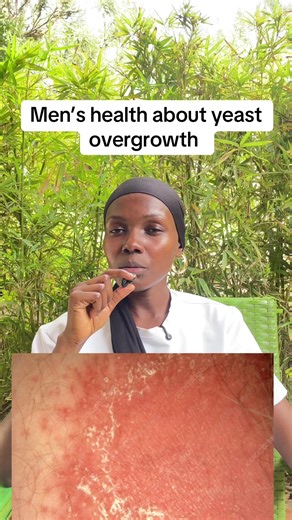 Men's Health: Understanding Yeast Overgrowth