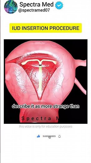 The IUD Insertion Explained: Small Device Big Freedom! | Long-Term Birth Control Made Simple#biology