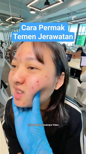 How to Make Over Acne-Prone Friends #skincare #skincaretips