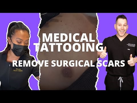 MEDICAL TATTOOING TO HIDE SURGICAL SCARS | Dr. Jason Emer