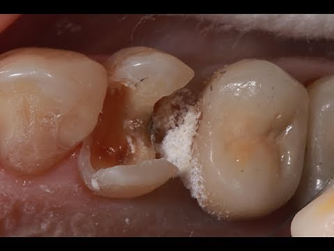 How to use caries dye indicator on badly destructed teeth