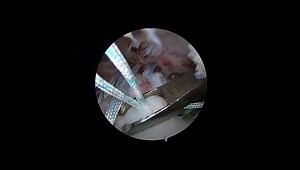 DERMIS ON DEMAND™ Allograft Arthroscopic Second Look