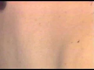 Intercostal Nerve Block