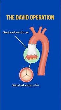 David Procedure: A Valve-Sparing Heart Surgery Explained #shorts