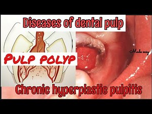 CHRONIC HYPERPLASTIC PULPITIS II PULP POLYP II DISEASES OF PULP II SERIES PART 4 II made easy