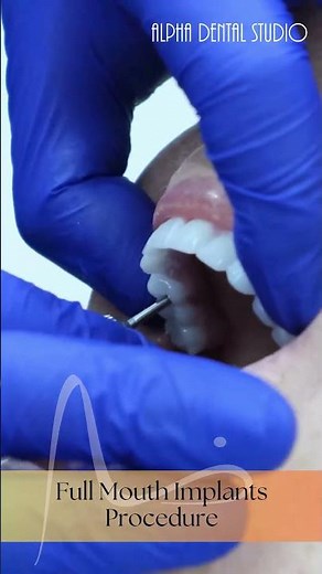 Full-mouth implant procedure at Alpha Dental Studio