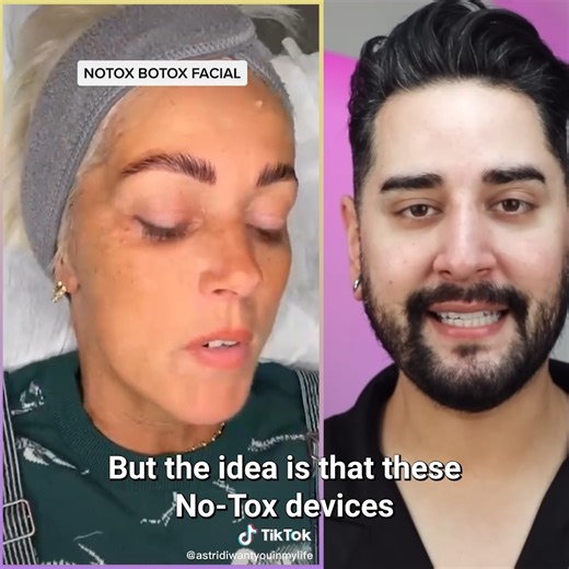 I’m Not a Fan of ”No-Tox” as an Alternative for Botox! #makeuptutorial #botoxfiller #mua | James Welsh