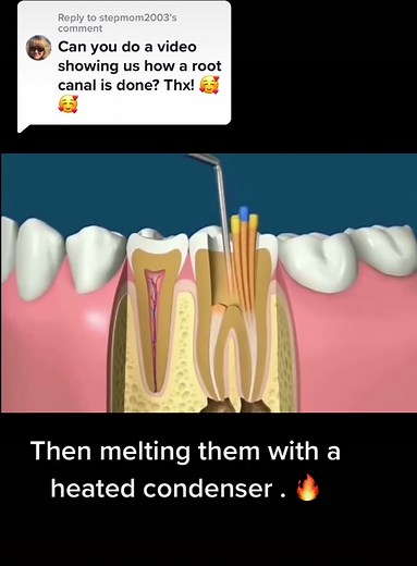 Root Canal Procedure Explained: Video Demonstration