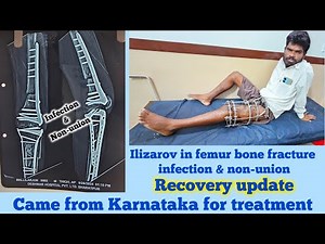 Femur and tibia bone fracture infection non-union bone Patient came from karnataka #ilizarovsurgery