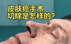 皮肤癌手术切除是怎样的？