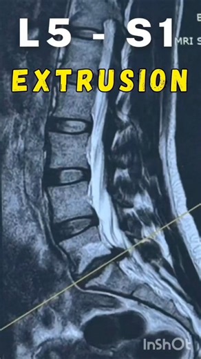 L5–S1 Lumbar Disc Extrusion Recovery — Without Surgery #discextrusion