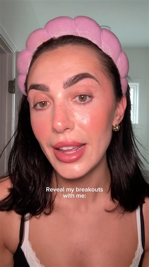 The power of makeup: Acne edition #acne #acneproneskin #relatable #acnetips #makeup #acnemakeup