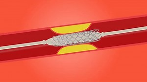 Stent Process Heart Stent Treatment Process Stock Footage Video (100% Royalty-free) 3475103255 | Shutterstock